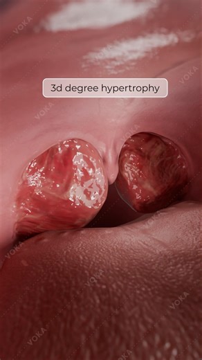 Palatine Tonsil Hypertrophy: Grading Immune Enlargement in 3D