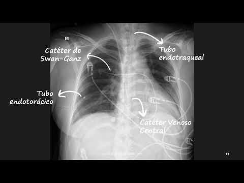 Tubes and lines in chest X-ray