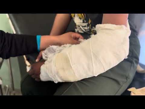 Staple removal after surgery