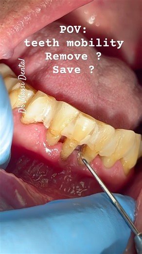 POV: teeth Mobility remove them or save them ?