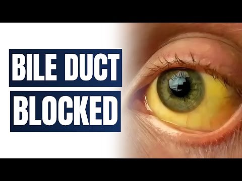 How interventional radiologist can fix blocked bile ducts