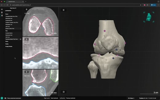 #orthopedics #medicaldevices #3dimaging #ai #patientspecificcare #digitalsurgery #innovation | Axial3D