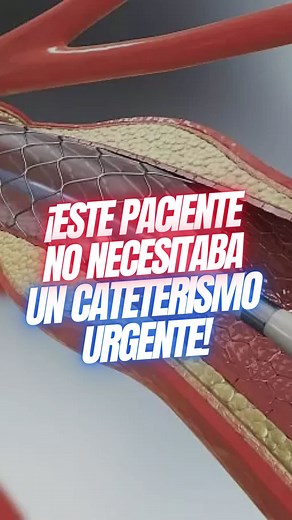 ⚠️ ¡Iban a llevarlo a un cateterismo urgente… y NO lo necesitaba! Muchos pacientes llegan con diagnósticos incompletos y, lamentablemente, con procedimientos ya programados sin la evidencia suficiente. Este caso lo demuestra: un paciente estaba a minutos de ser sometido a un cateterismo innecesario, algo que pudo evitarse con una evaluación correcta. 💡 Realizar estudios completos, interpretar bien los resultados y buscar una segunda opinión puede ser la diferencia entre un tratamiento adecuado…