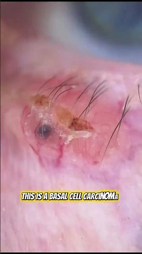 👁 Yes, you can get skin cancer on the eyelid