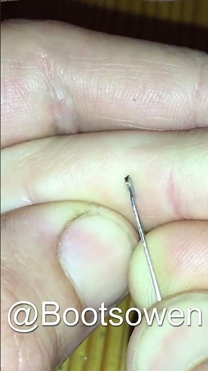 Huge splinter in my finger easily removed with pin and tweezers NO PAIN!