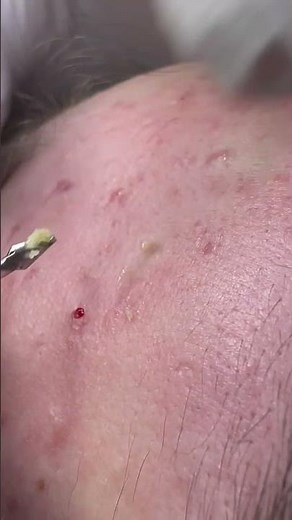 Forehead comedone extractions