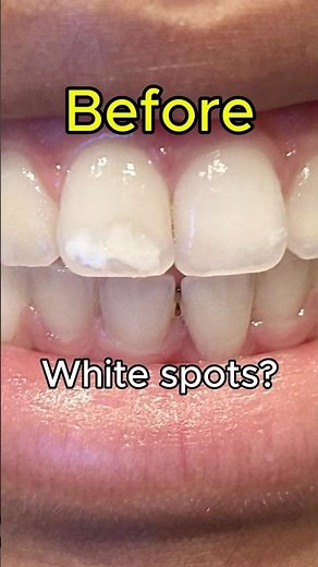 White Spots on Teeth? Here's a Fix with No Shots or Drills! #texaschoicedental