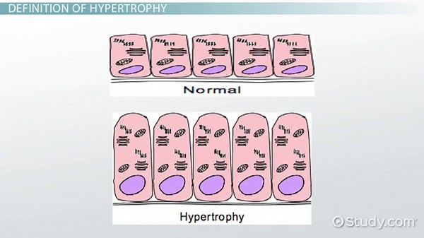 Hypertrophy | Causes, Symptoms & Treatment