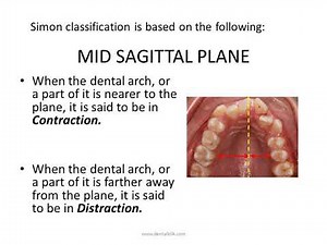 SIMON's CLASSIFICATION of MALOCCLUSION