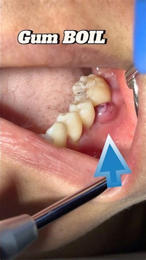 Dental periodontal Abscess #shorts #dental #video #shortvideo