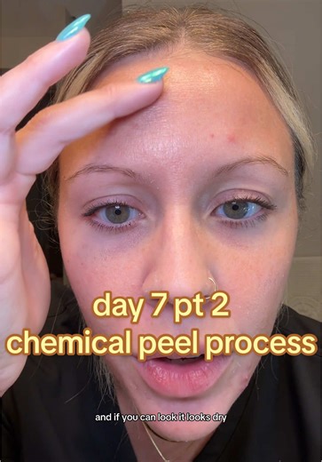 Chemical Peel Process: Day 7 Insights and Review