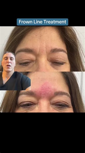 Frown Line Treatment 11 lines / frown lines / glabella lines are vertical lines that are created by squeezing the brow muscles to the center. When the lines are deeper and have been carved into the skin, the correction of these wrinkles requires a combination of Botox and fillers: Botox to relax the muscle movement and fillers to correct the etched-in quality of the wrinkles. This area is considered to be a higher-risk area for filler injections, so make sure you see an experienced doctor for fi