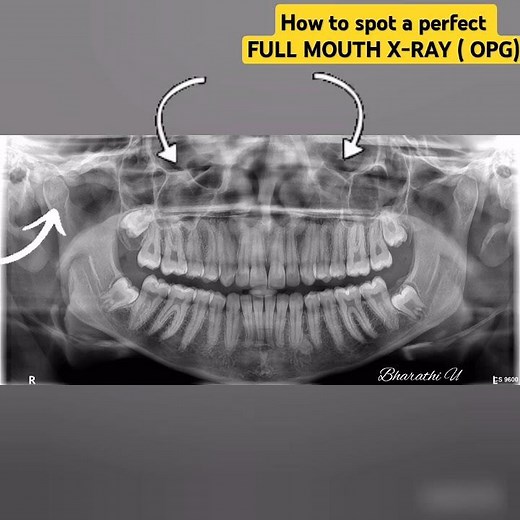 how to spot a perfect full mouth x ray / OPG #dentist #dental #dentalcare