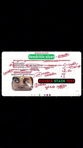 Dentritic ulcer #opthalmology #eyes #cornea