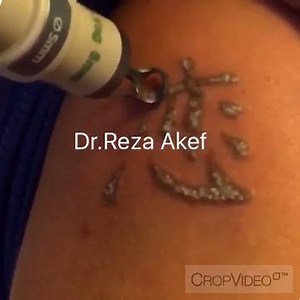Watch 1 Minute of the Tattoo Removal Process