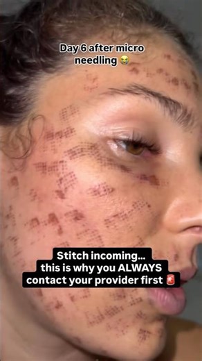 Stitch incoming…thid is why you ALWAYS contact your provider first 🚨