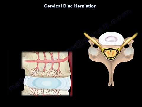 Cervical Disc Herniation What Is The Intervertebral Disc? what is a disc herniation.