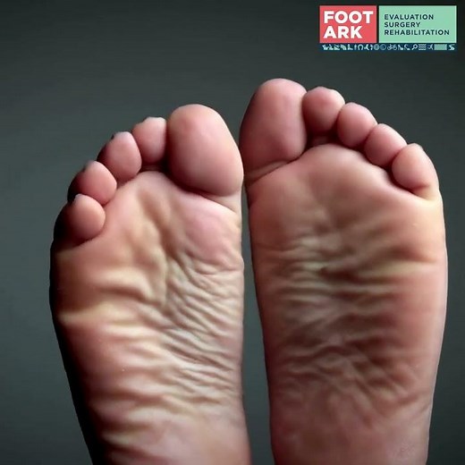 Understanding Flat Feet By Dr. Abhishek Kini – Foot & Ankle Specialist