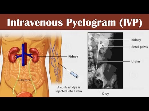 Intravenous pyelogram (IVP)?