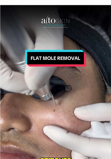 Flat Mole Removal: Safe and Precise Techniques
