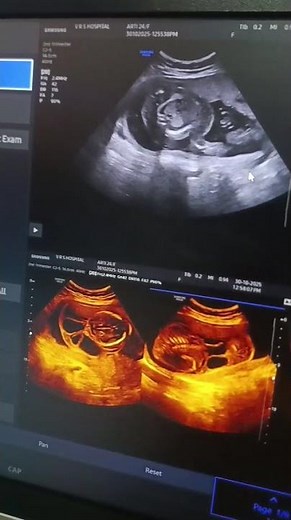 Hydrops fetalis with fetal anasarca Cystic hygroma