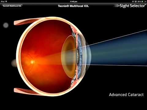 Tecnis multifocal IOL