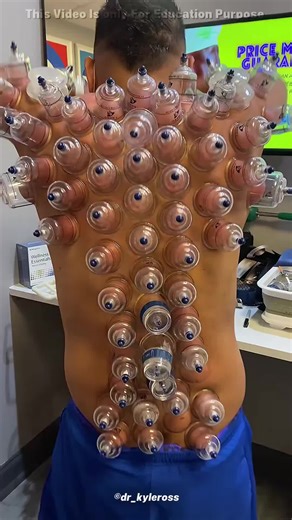 What Really Happens in Cupping Therapy 🤯 #history #historyfacts #story #insteresting