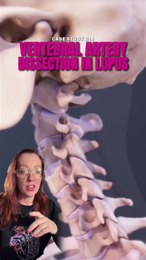 Estudio de Caso 218: Disección de Arteria Vertebral en Lupus