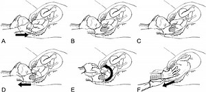Shoulder Shrug Maneuver to Facilitate Delivery During... : Obstetrics & Gynecology