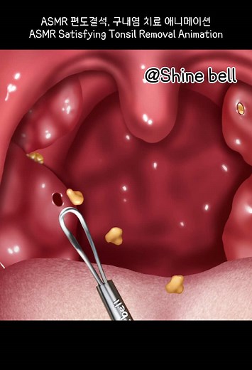 ASMR 편도결석, 구내염 치료 애니메이션 Tonsil removal