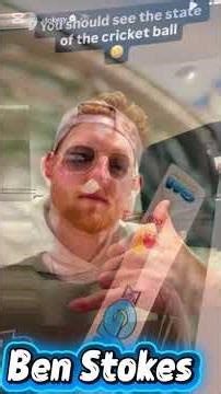 “🚨 Ben Stokes Injured! Successful Surgery After Shocking Net Accident"