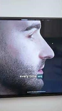 Male Rhinoplasty Journey: Watch Me Morph in Real Time