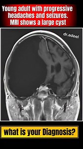 Can You Spot the Diagnosis? 🧠 Answer in description This MRI brain shows a very large arachnoid cyst on the right side of the brain. The cyst measures 12.3 × 16.5 × 7.9 cm and is filled with CSF-like fluid. Because of its size, it is pressing on the right cerebral hemisphere, pushing the temporal lobe upward and backward, and causing a shift of the brain’s midline structures. Large arachnoid cysts can present with headache, seizures, or raised intracranial pressure, and imaging is key to diagno