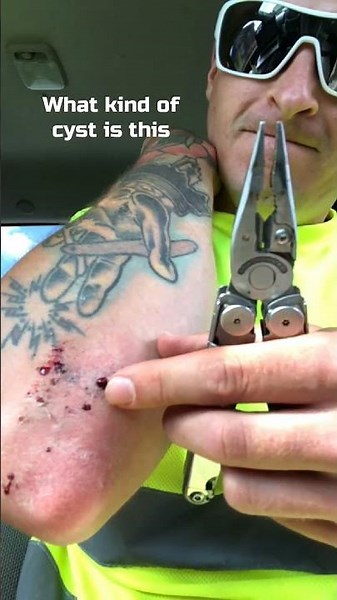 What kind of cyst is this