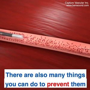 15K views | Clot removal Animation | Medical & Health | Facebook