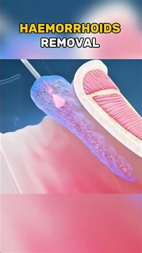 Haemorrhoids removal 3d Animations. Haemorrhoid removal helps you fin...