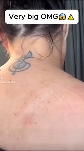 😱 You won't believe what came out of this one... #pimplepop #satisfying | Blackheads Popping