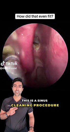 Quick and Effective Sinus Cleaning Techniques Explained