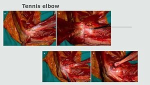 Tennis Elbow - Lateral Epicondylitis
