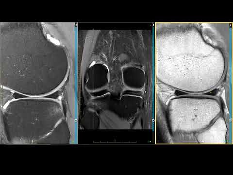 Meniscus - Medial Intrameniscal Tear