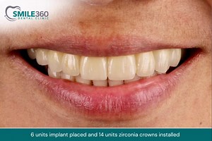 5.8K reactions · 245 shares | Missing teeth? 醴 We've got you covered with fixed bridges, dentures, or implants! Let's find the best solution for your smile. Send us a PM for inquiries and appointment! #Smile360DentalClinic #smile360transformation #dentalbridge #implants #dentures | Smile 360 Dental Clinic | Facebook