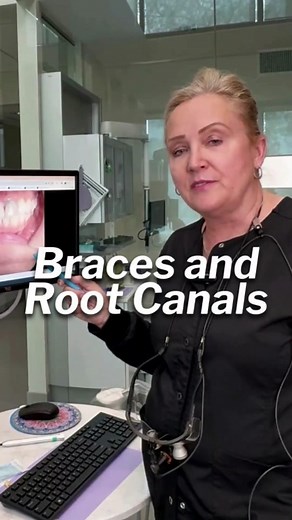 🤨Do Braces before extracting a root canal? With orthodontics, often, we're going to keep that root canal. We are doing braces first to put the teeth in the right position, and then we decided to extract and replace the tooth. This patient wanted a bridge instead of an implant, so we will do 2 crowns, and her smile will be very nice 😁 To learn more about Holistic Dentistry 👉 Follow us! ✨ #rootcanals #naturaldentistry #dentalcareworld