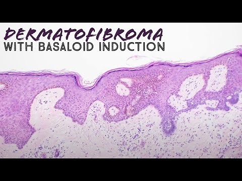 Dermatofibroma with basaloid follicular induction (pathology mimic of basal cell carcinoma) dermpath