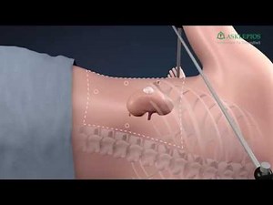 Kidney - retroperitoneoscopic partial resection: Asklepios Information Film