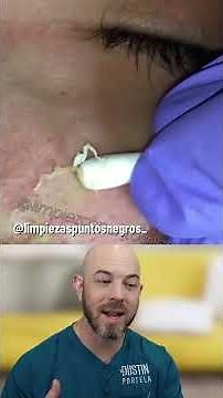 Dermatologist Reacts: Blackhead Removal with Q-Tips (We Need a Part 2!)