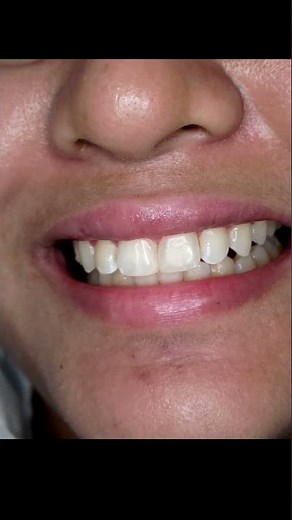 Immediate Fix for GAPS OR SPACES for your front teeth/ DIASTEMA CLOSURE/COSMETIC RESTORATION #shorts