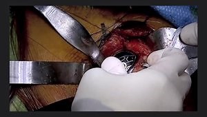 Lesser Tuberosity Osteotomy and Repair in Stemless Arthroplasty