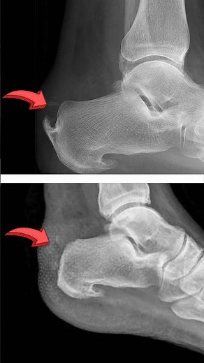 Removing a Bone Spur!! Amazing 🤩