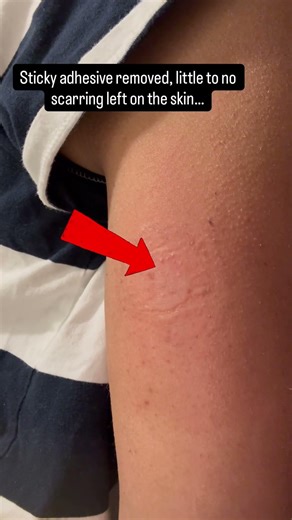 Removing my Dexcom G7 sensor!! @dexcom petroleum jelly from @drugemporium_littlerock