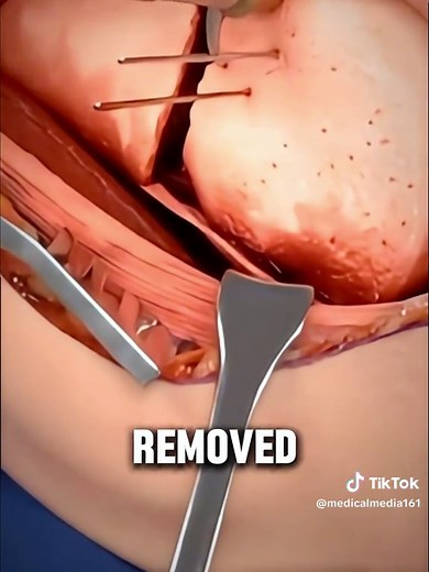 How Doctors Repair the Knee with Arthroscopy (Knee Arthroscopy is a minimally invasive procedure used to diagnose and treat problems inside the Knee Joint. Surgeons insert a small camera called an Arthroscope through tiny incisions, allowing them to repair damaged cartilage, ligaments, or other structures while reducing recovery time compared with open surgery) #KneeArthroscopy #KneeSurgery #OrthopedicSurgery #medicalanimation